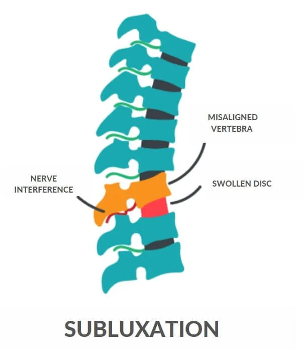 Chiropractic subluxation on the vertebral spine