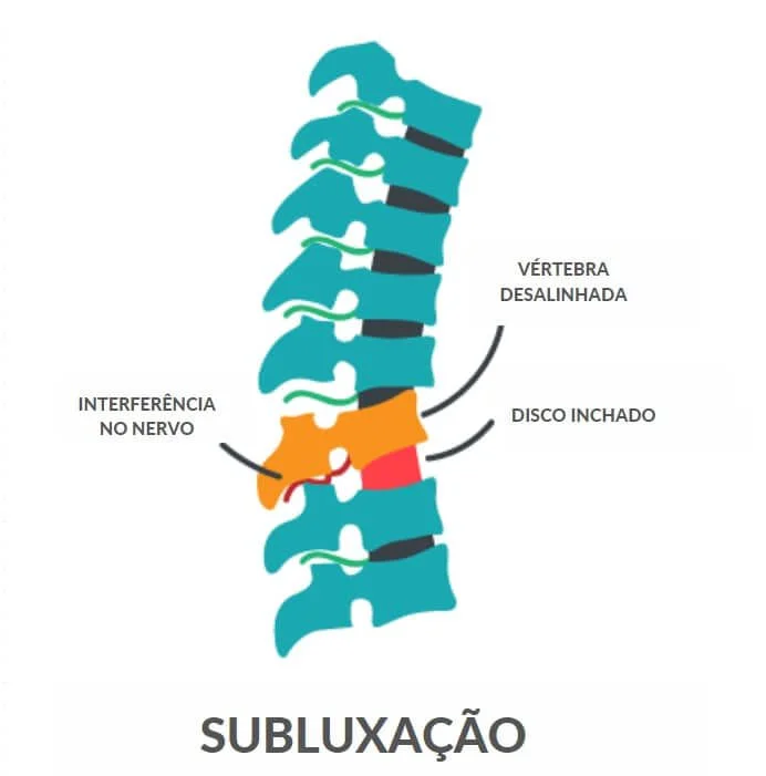 Subluxação quiroprática na coluna vertebral